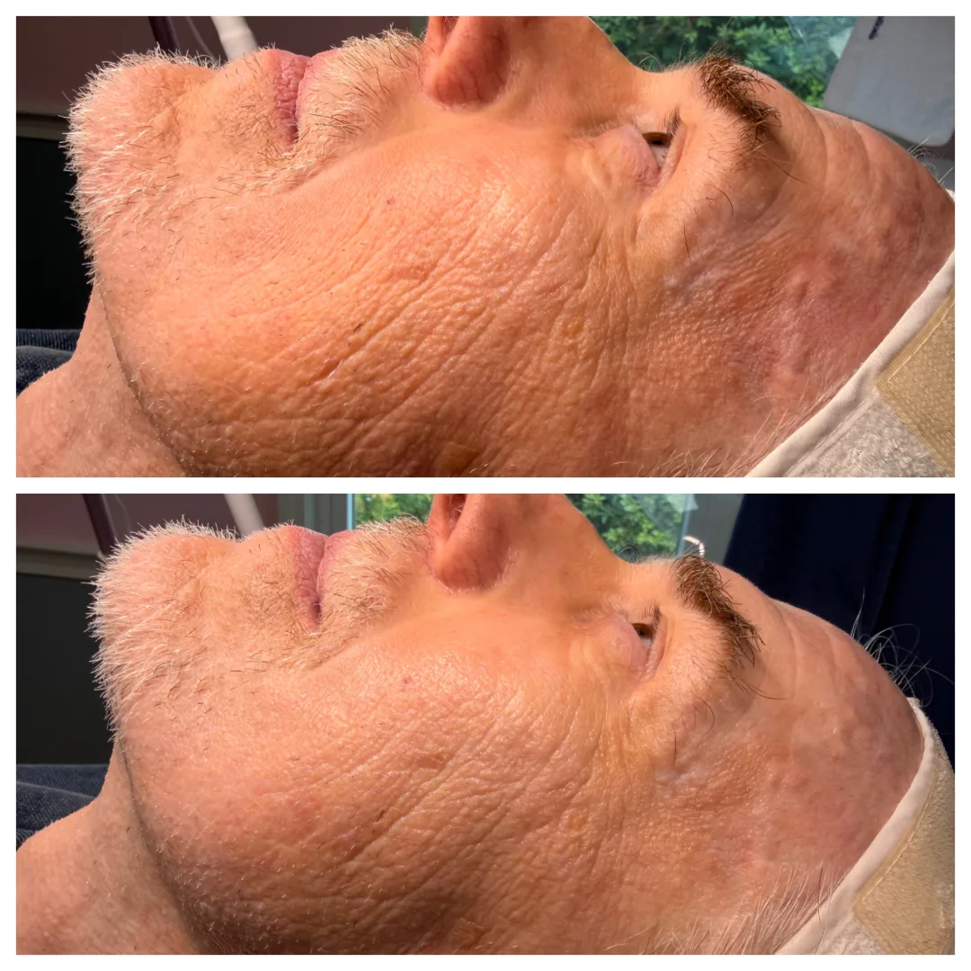 Before and after Advanced Ultrasound Skin Rejuvenation — older male client, jaw and neck in side profile