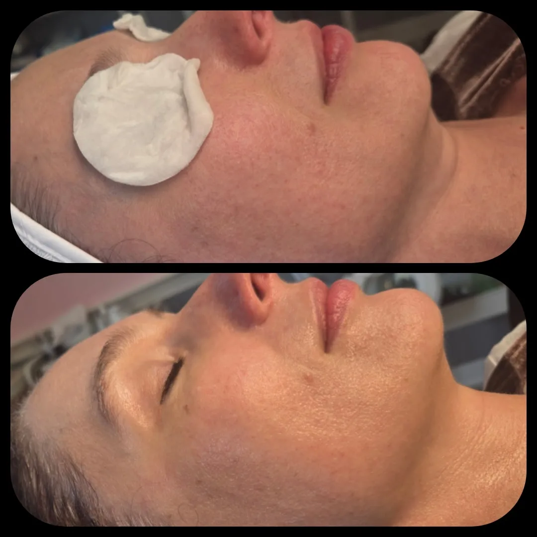 Before and after Advanced Ultrasound Skin Rejuvenation — female client, cheek and jaw in side profile