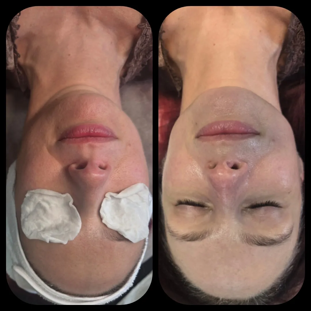 Before and after Advanced Ultrasound Skin Rejuvenation — female client, full face