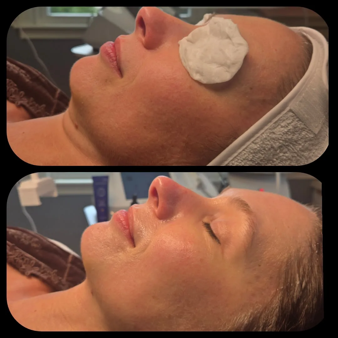 Before and after Advanced Ultrasound Skin Rejuvenation — female client, cheek and jaw in side profile