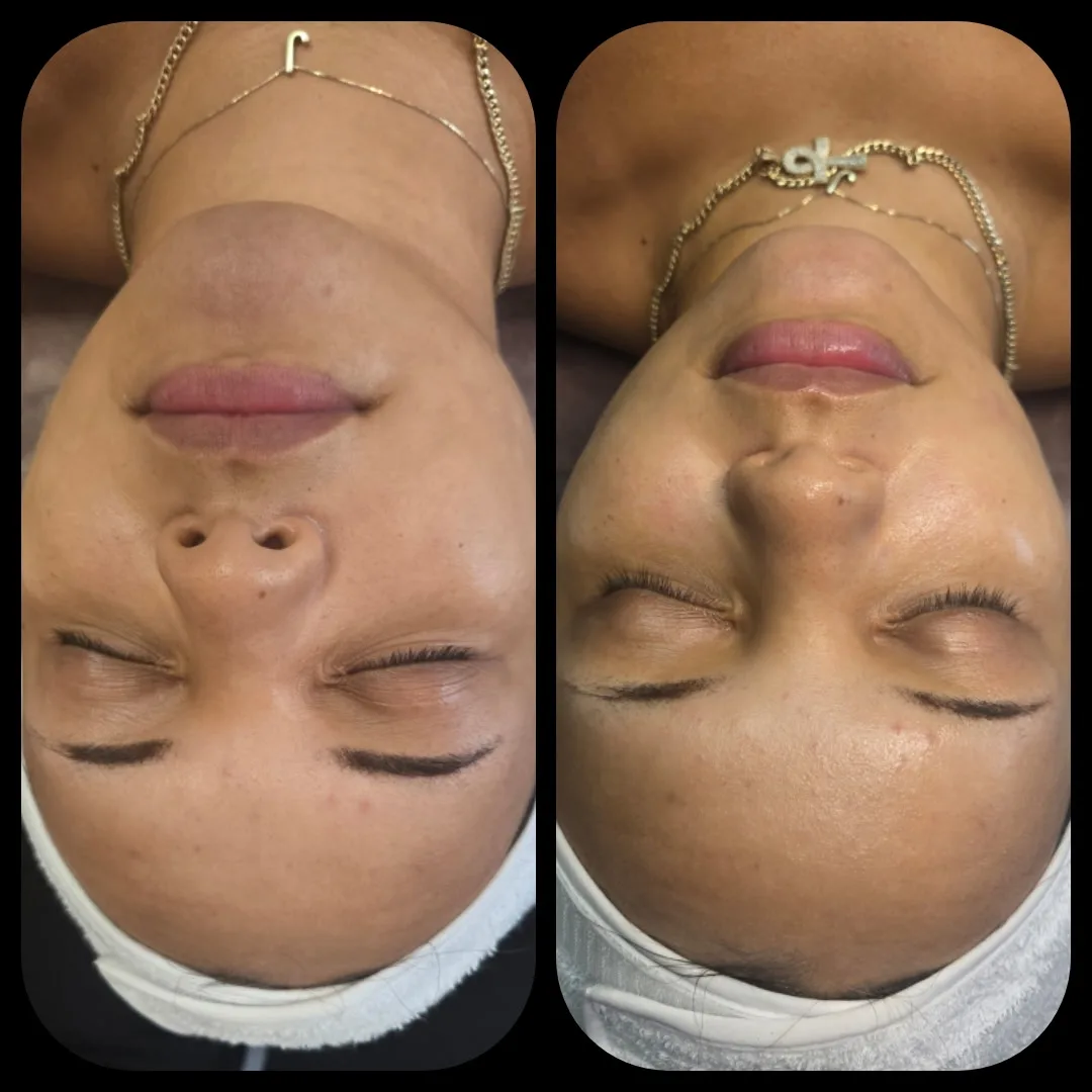 Before and after Advanced Ultrasound Skin Rejuvenation — female client with a deeper skin tone, full face