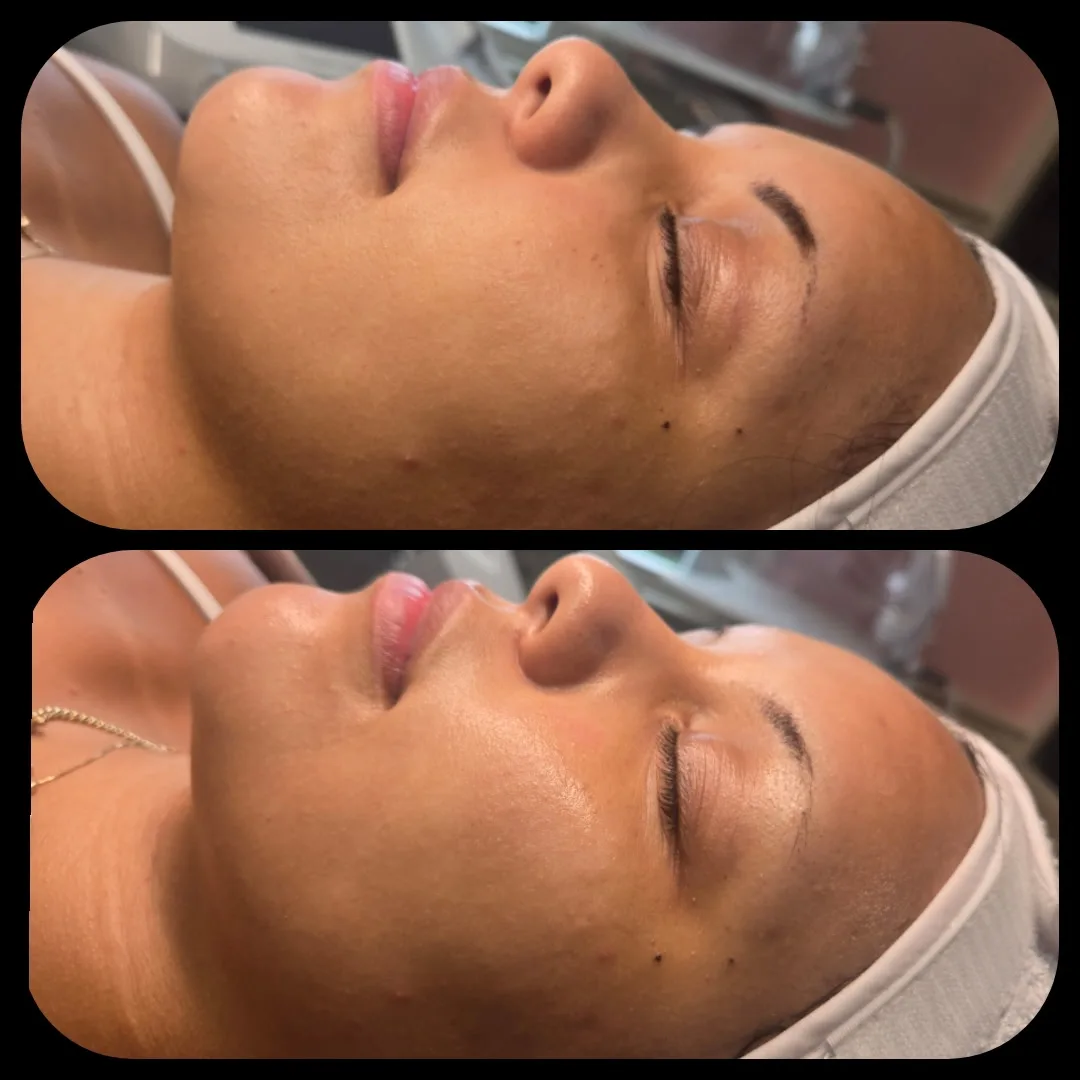 Before and after Advanced Ultrasound Skin Rejuvenation — female client with a deeper skin tone, side profile